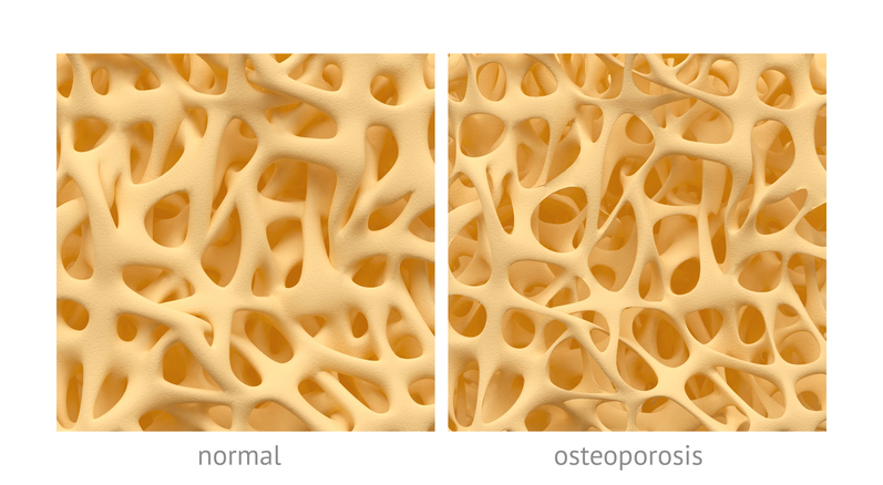 ben med normal struktur og med struktur ved osteoporose